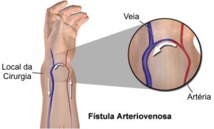 fistula-para-hemodialise-03