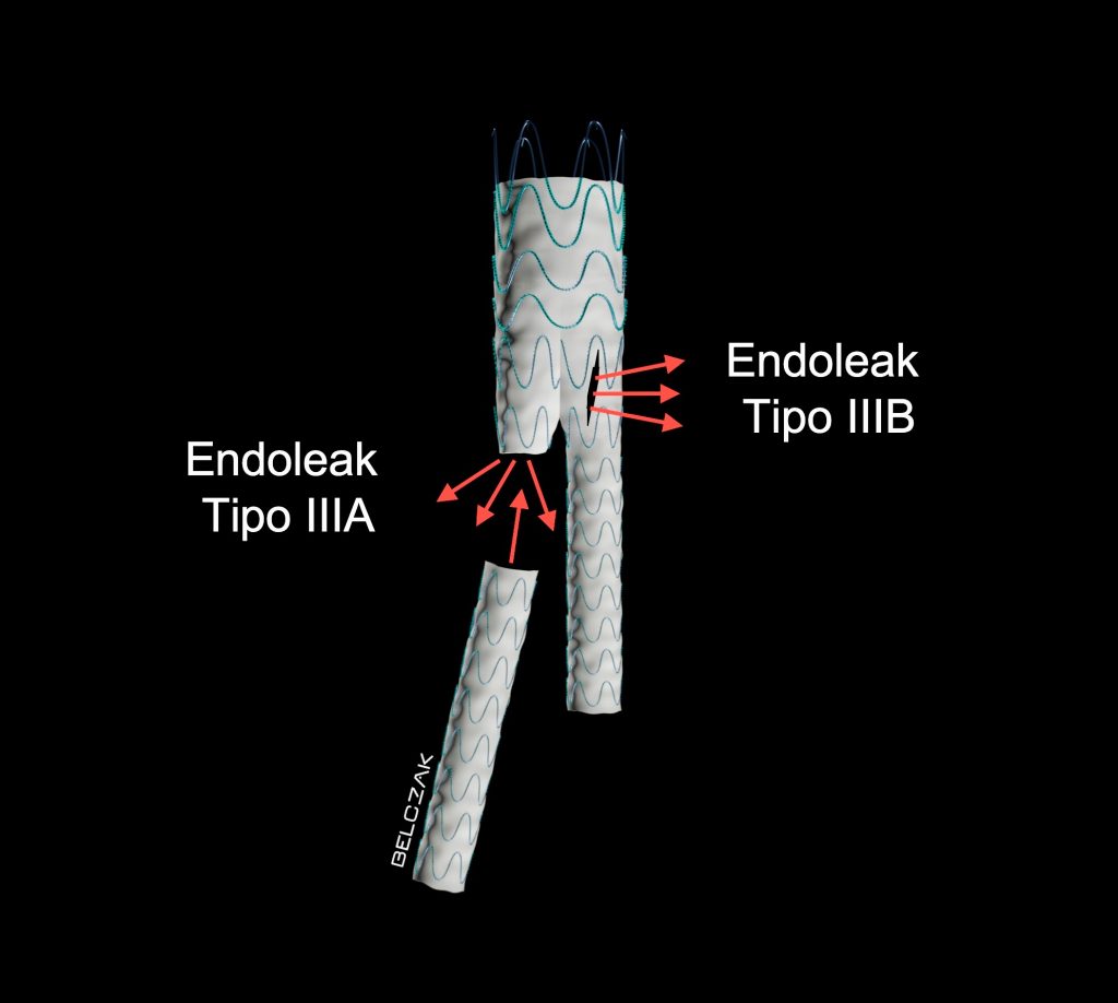 Endoleak tipo III